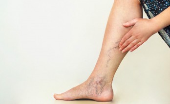 Don't suffer from varicose veins while staying away from the coronavirus